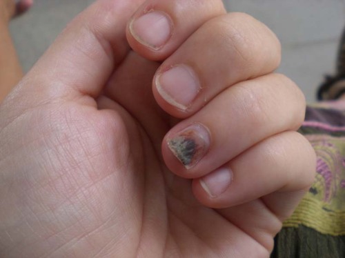 healing fingernail
