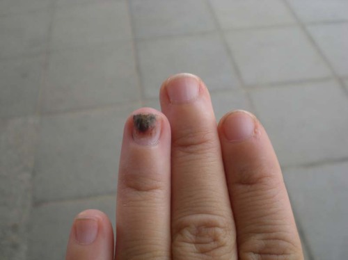 healing nail